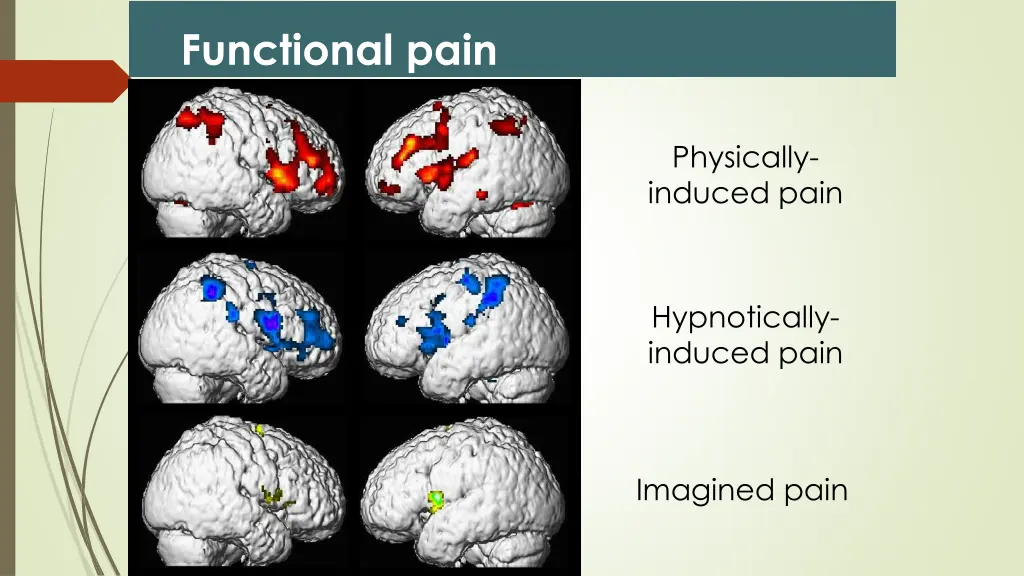 functional pain