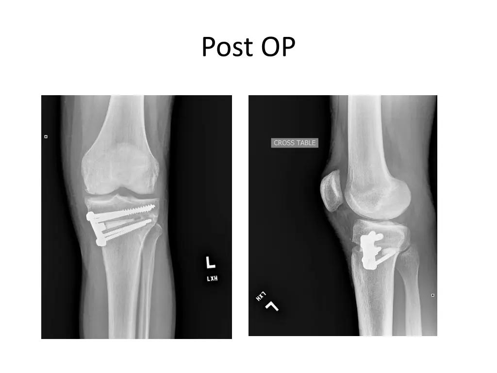 post op