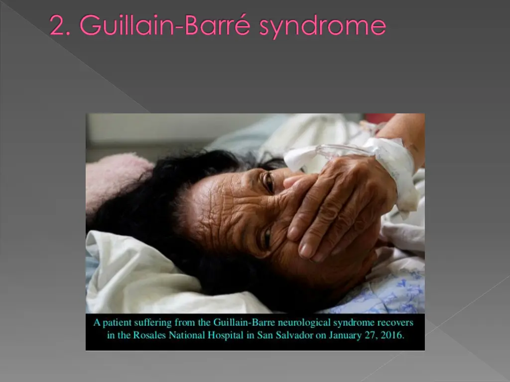 2 guillain barr syndrome