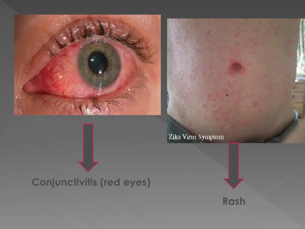 conjunctivitis red eyes