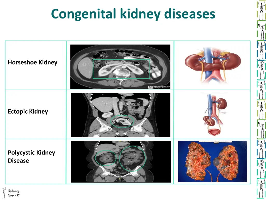congenital kidney diseases