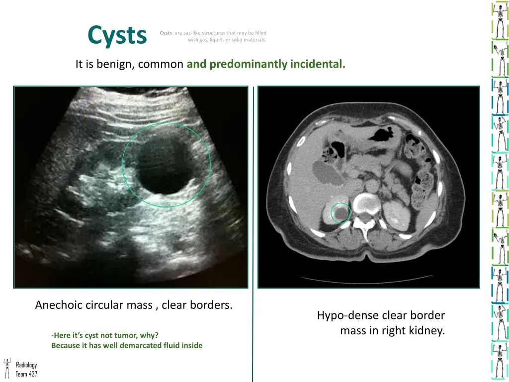 cysts