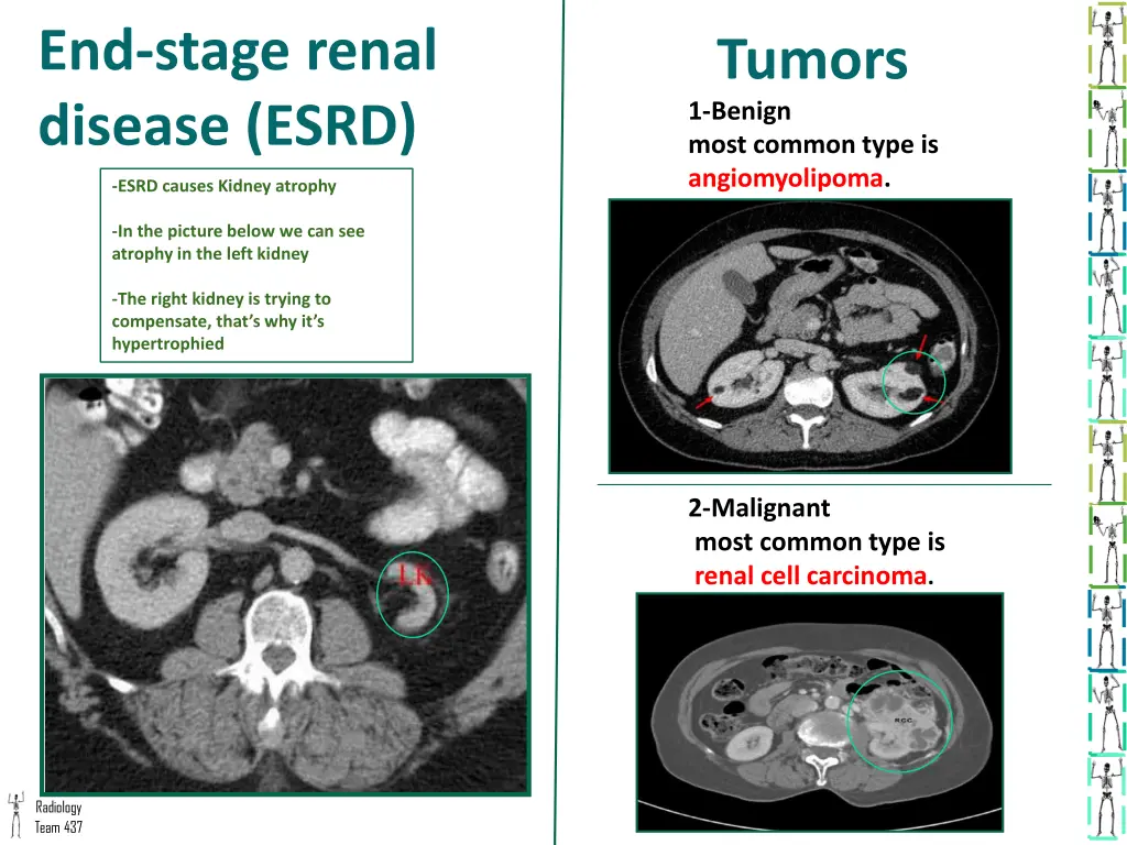 end stage renal disease esrd