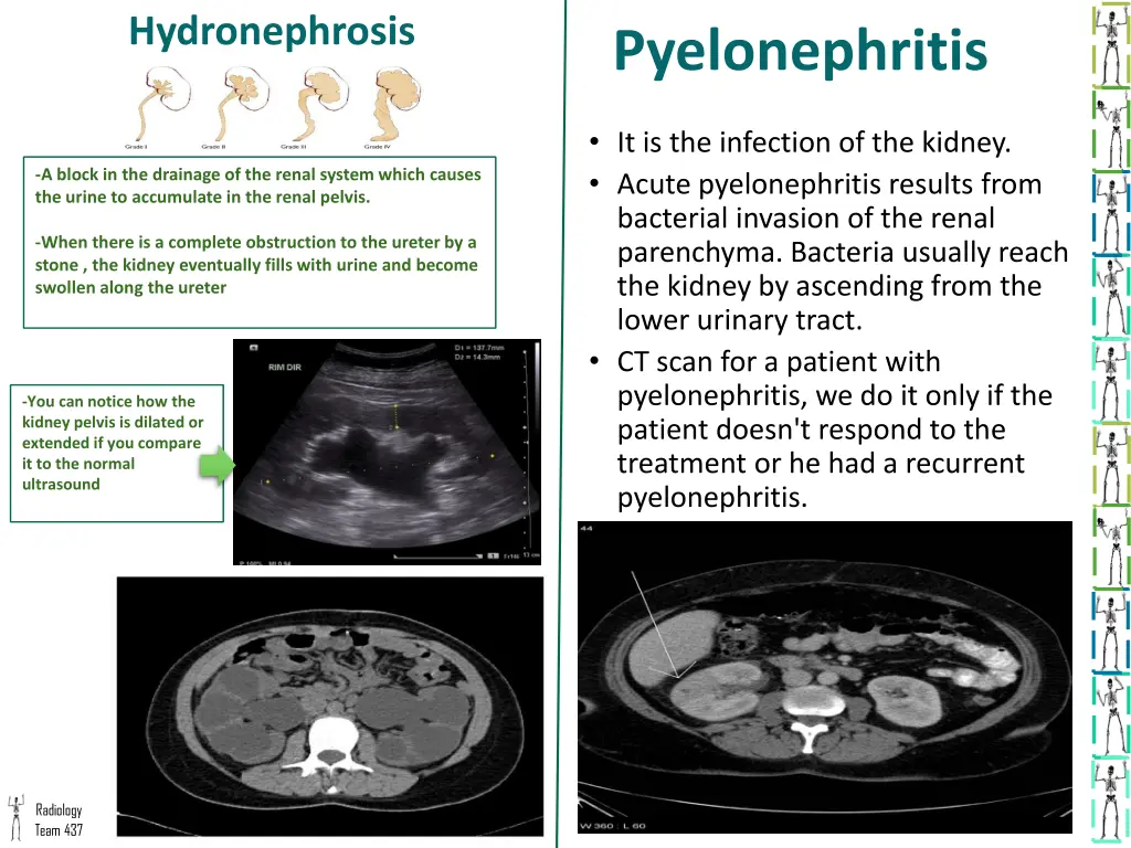 hydronephrosis