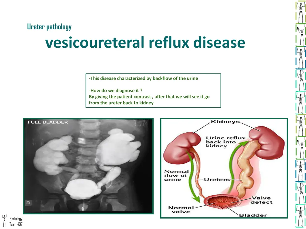 ureter pathology