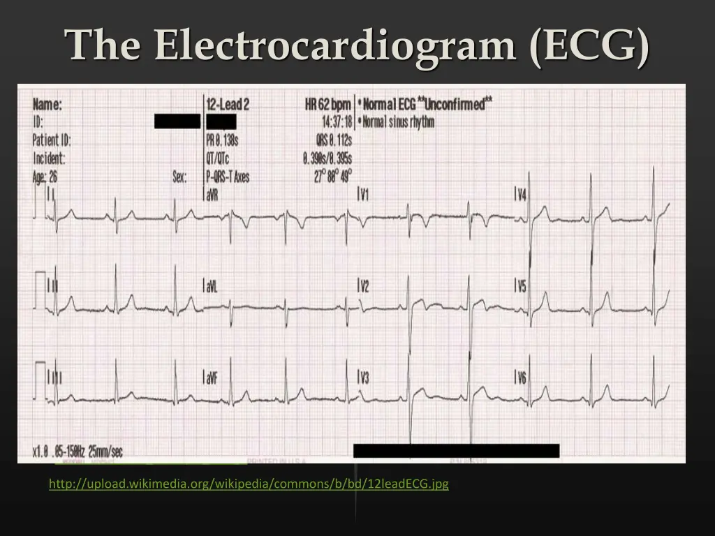 the electrocardiogram ecg