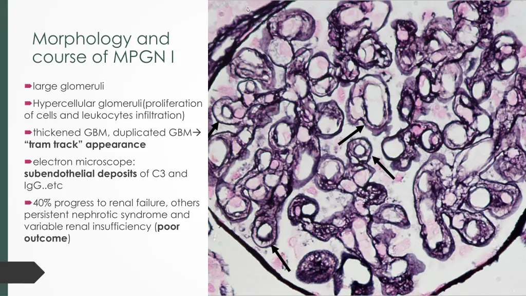 morphology and course of mpgn i