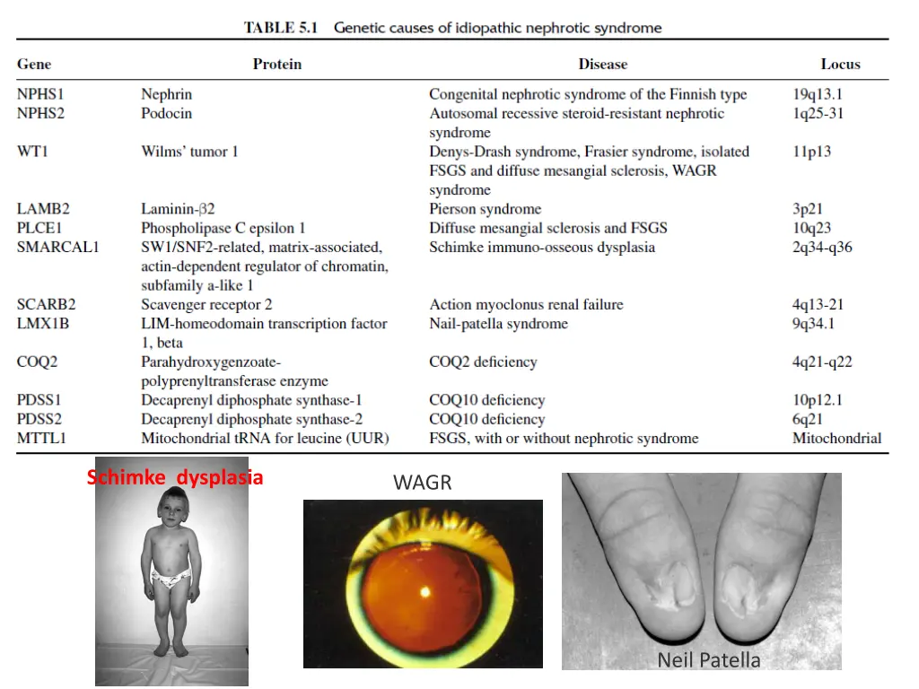 schimke dysplasia