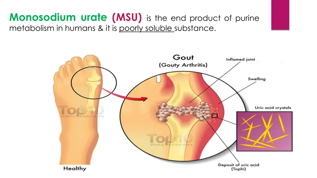 monosodium urate msu is the end product of purine