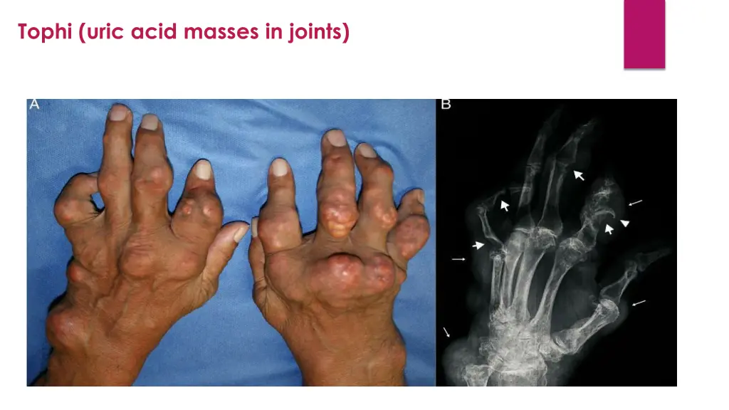 tophi uric acid masses in joints 1