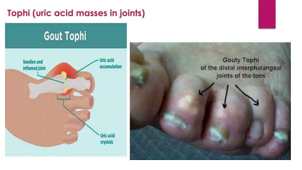 tophi uric acid masses in joints