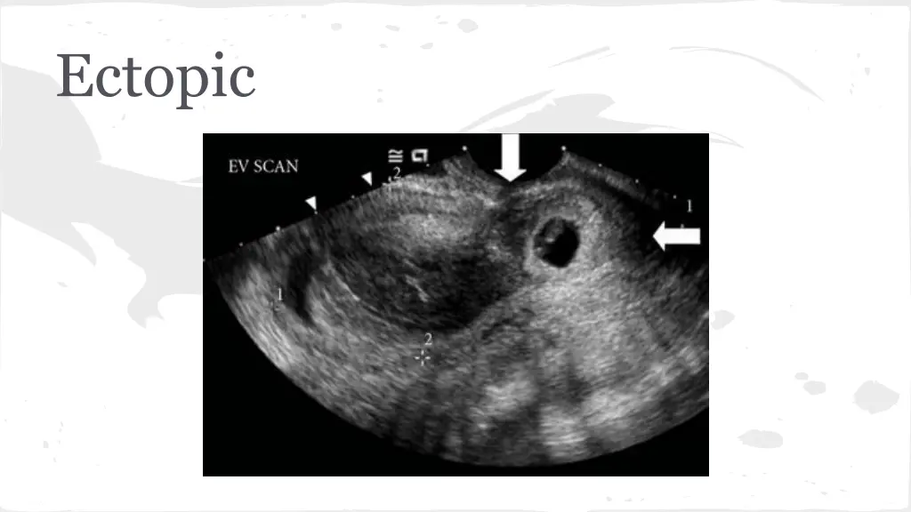 ectopic