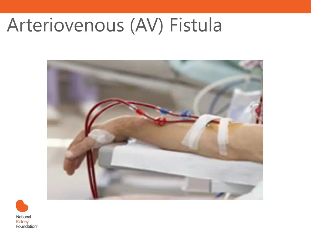 arteriovenous av fistula