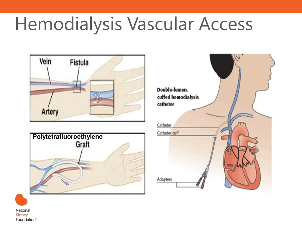 hemodialysis vascular access