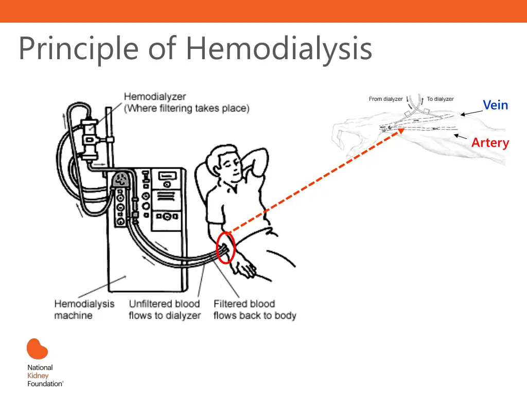 principle of hemodialysis