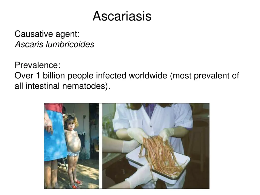 ascariasis