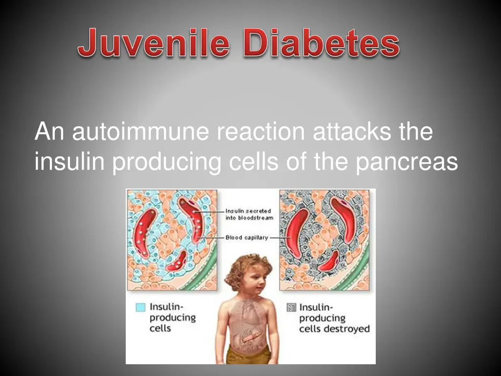 an autoimmune reaction attacks the insulin