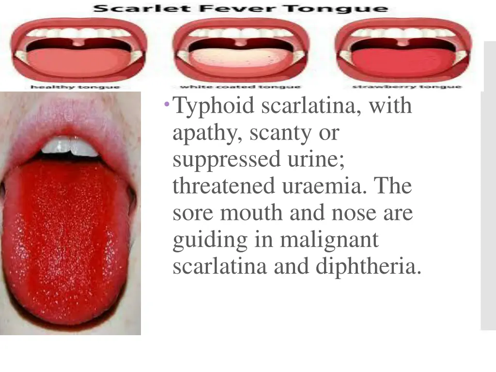typhoid scarlatina with apathy scanty