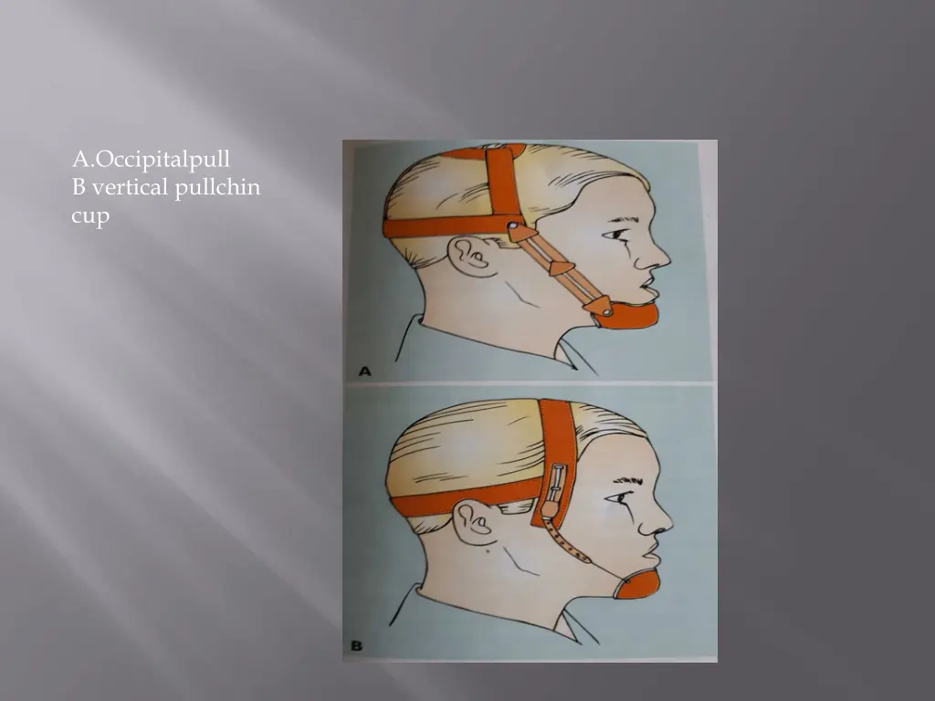 a occipitalpull b vertical pullchin cup