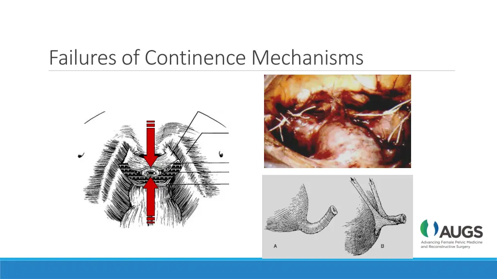 failures of continence mechanisms