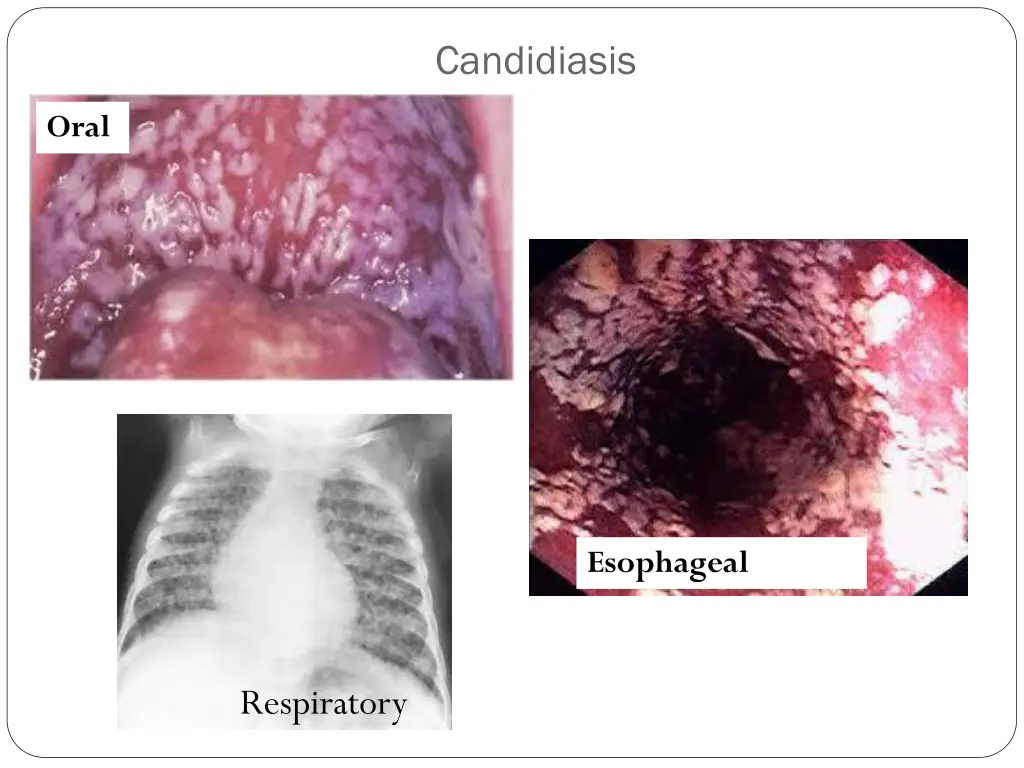 candidiasis
