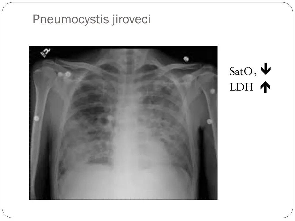pneumocystis jiroveci
