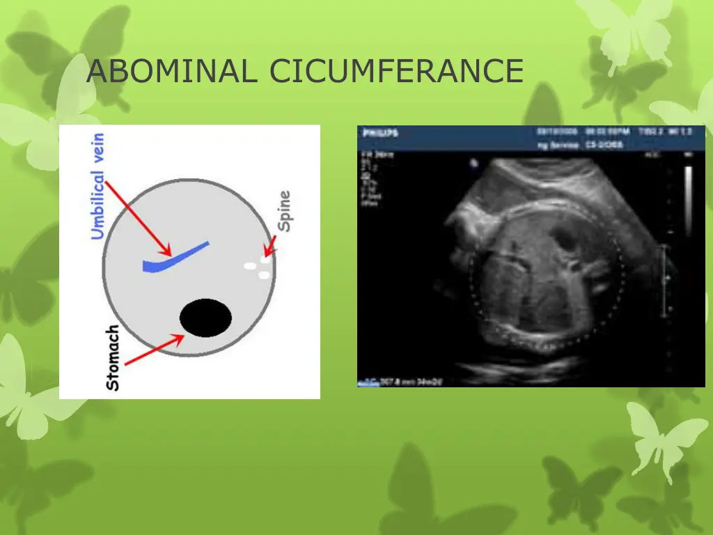 abominal cicumferance