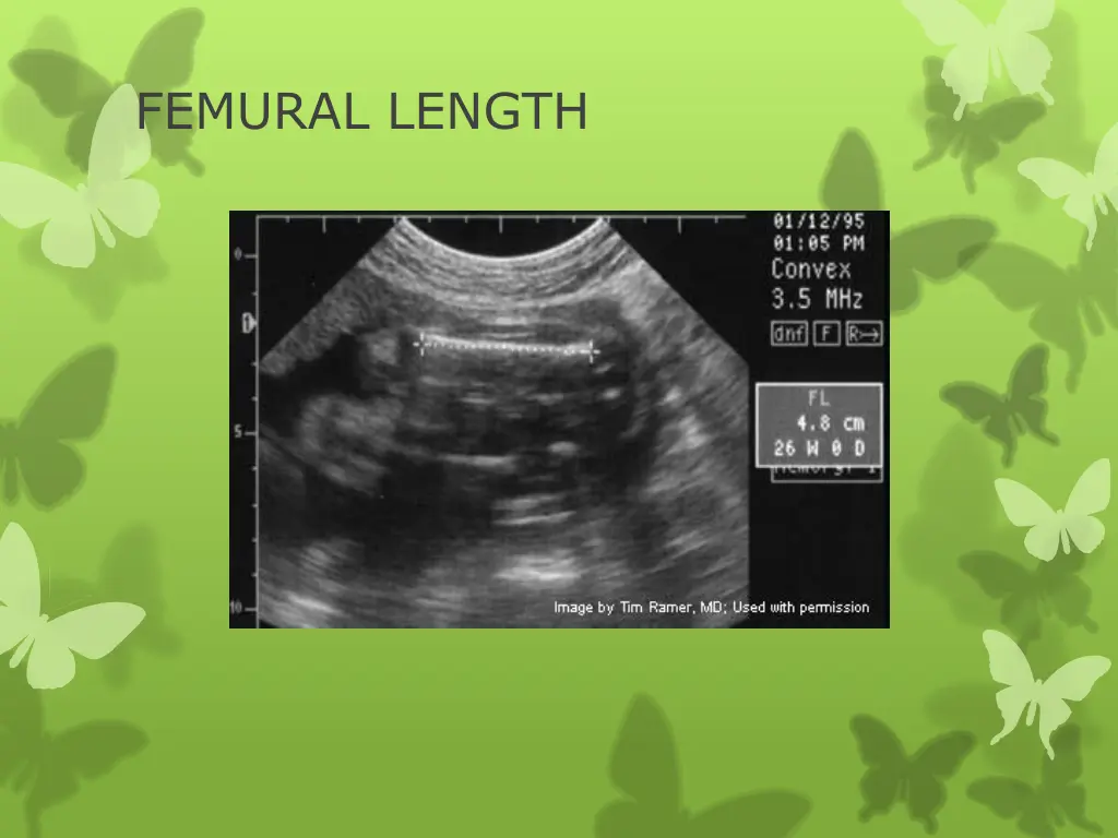 femural length