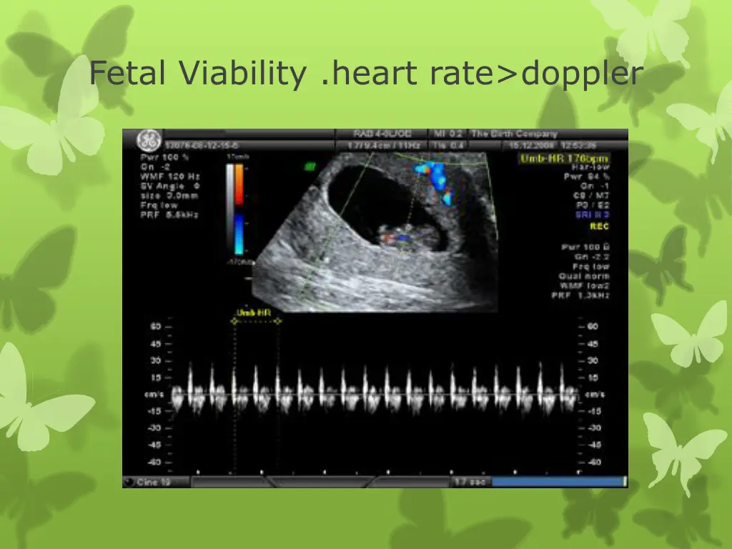 fetal viability heart rate doppler