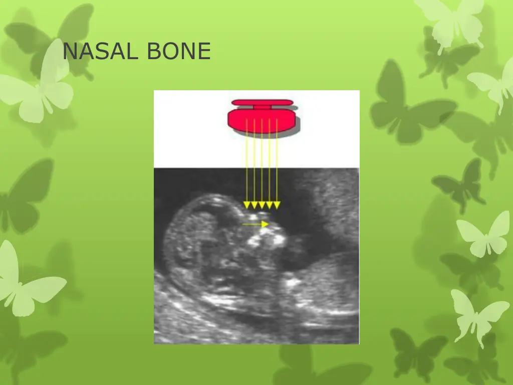 nasal bone