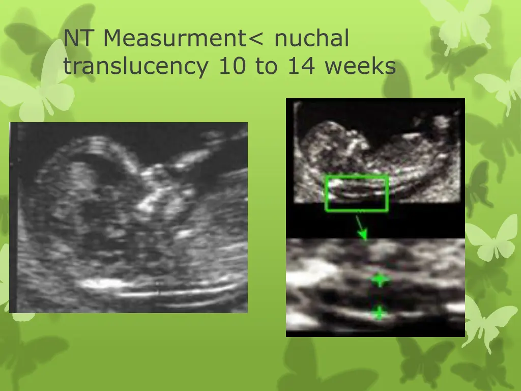 nt measurment nuchal translucency 10 to 14 weeks