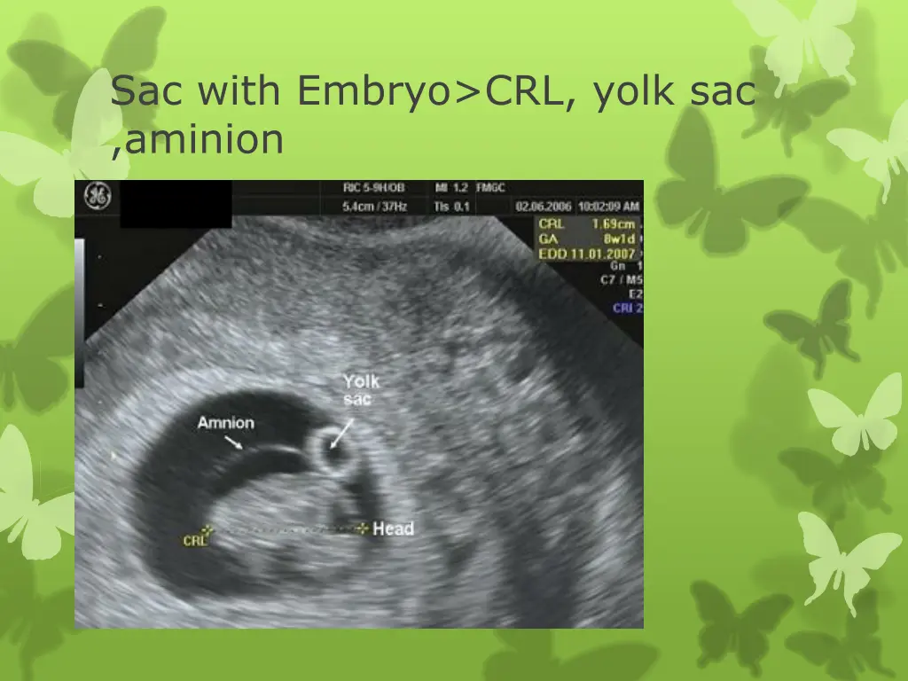 sac with embryo crl yolk sac aminion