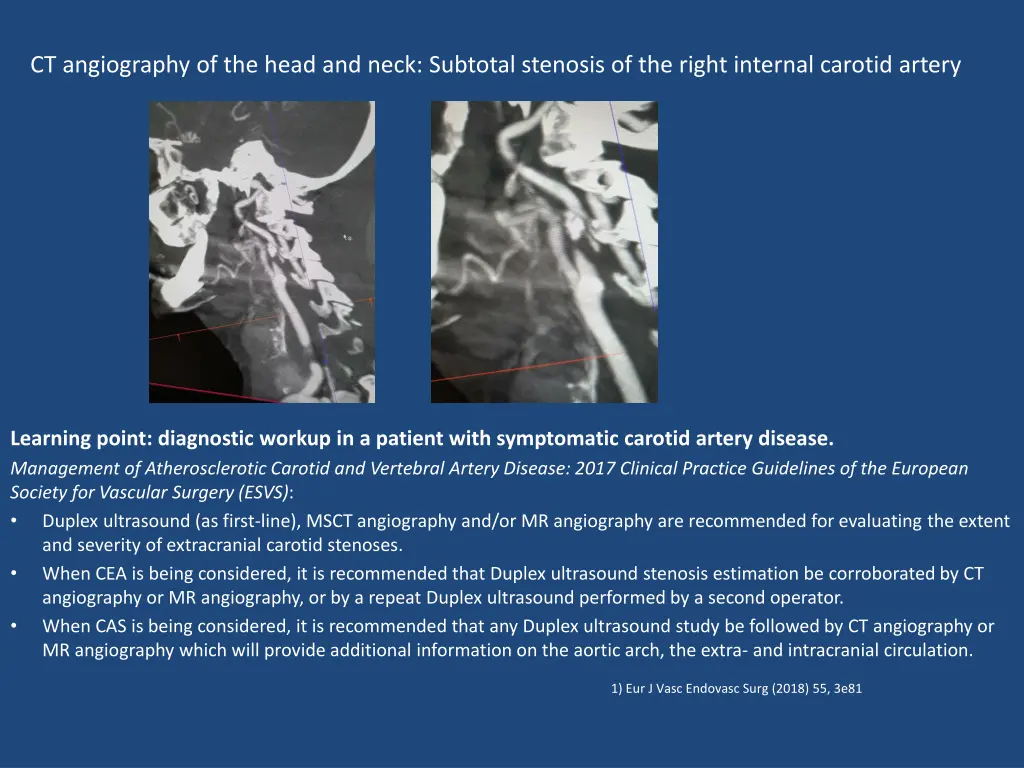 ct angiography of the head and neck subtotal