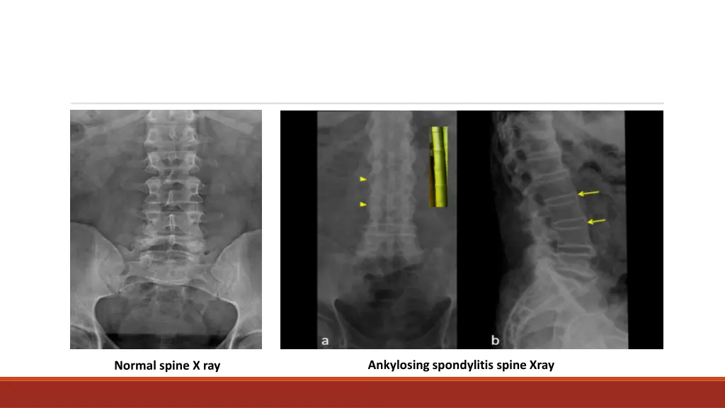 ankylosing spondylitis spine xray