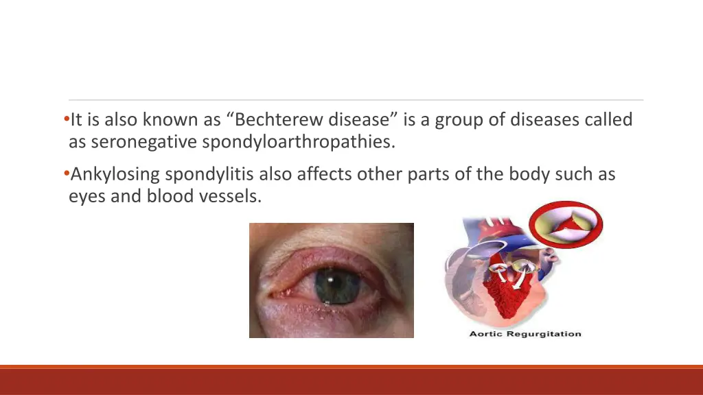it is also known as bechterew disease is a group