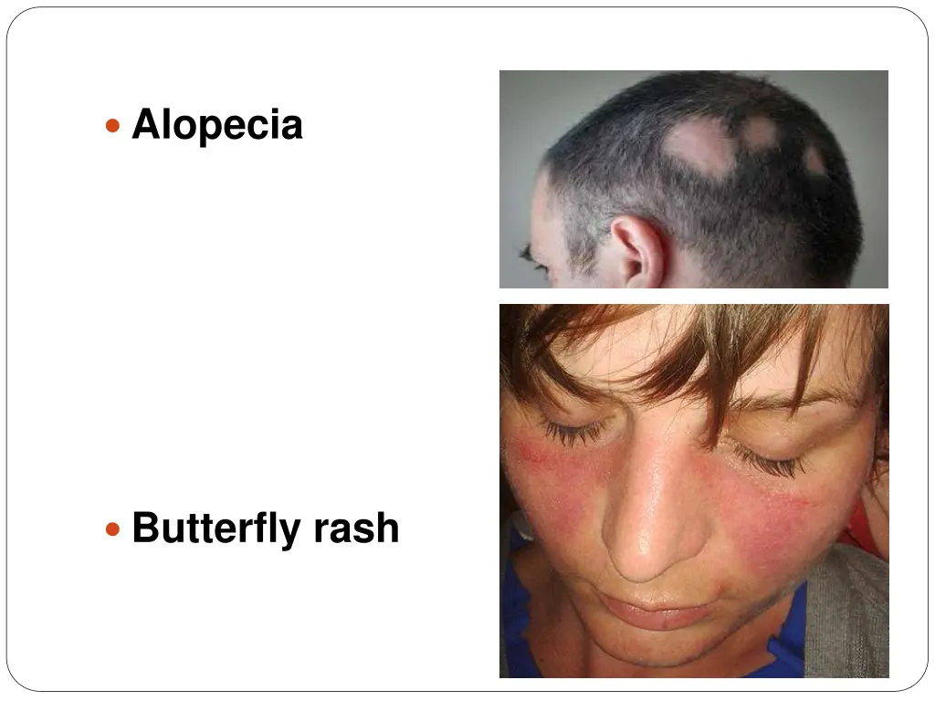 alopecia