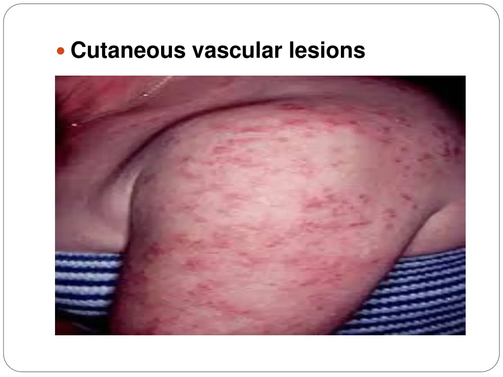 cutaneous vascular lesions