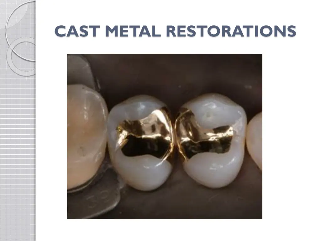 cast metal restorations