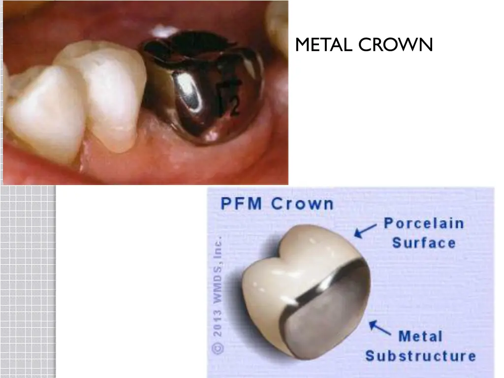 metal crown