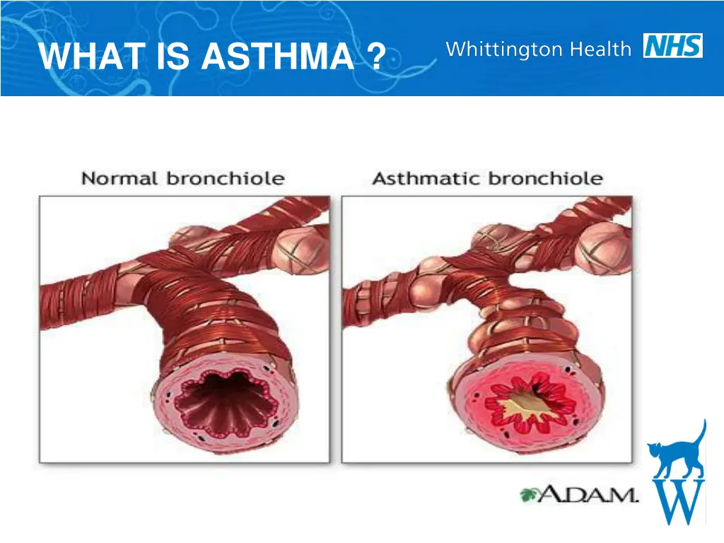 what is asthma