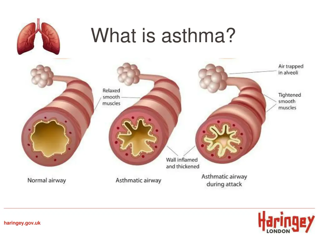 what is asthma