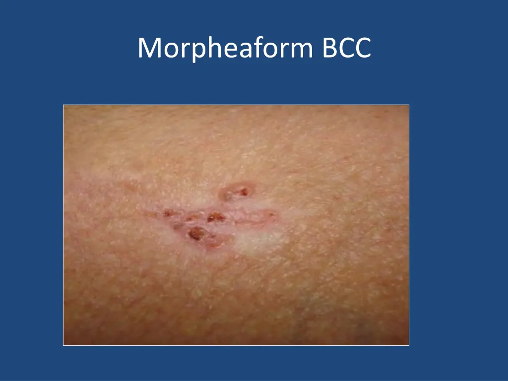 morpheaform bcc