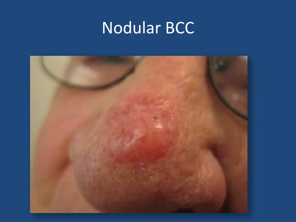 nodular bcc