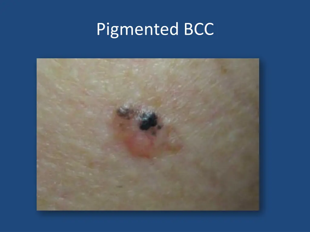 pigmented bcc