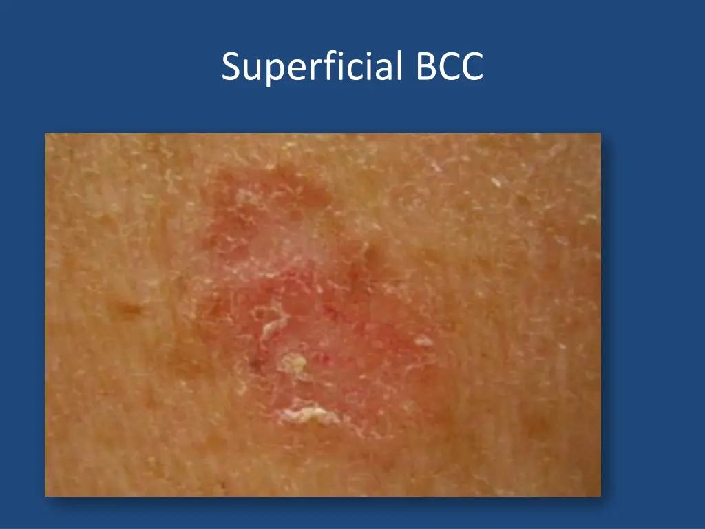 superficial bcc