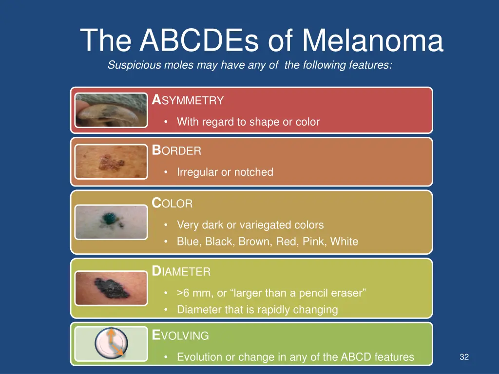 the abcdes of melanoma suspicious moles may have