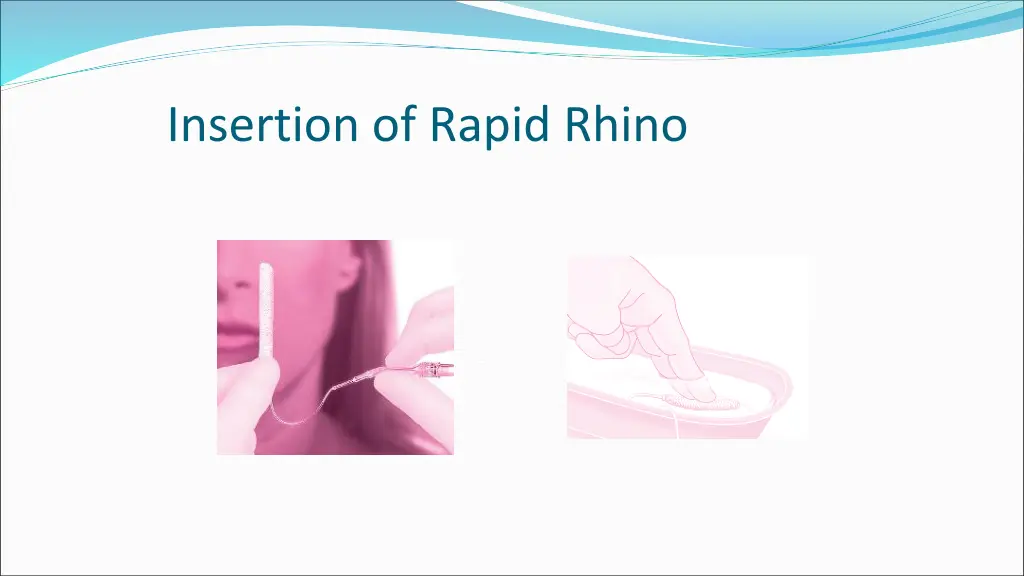 insertion of rapid rhino