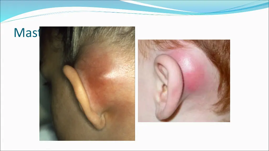 mastoiditis 1