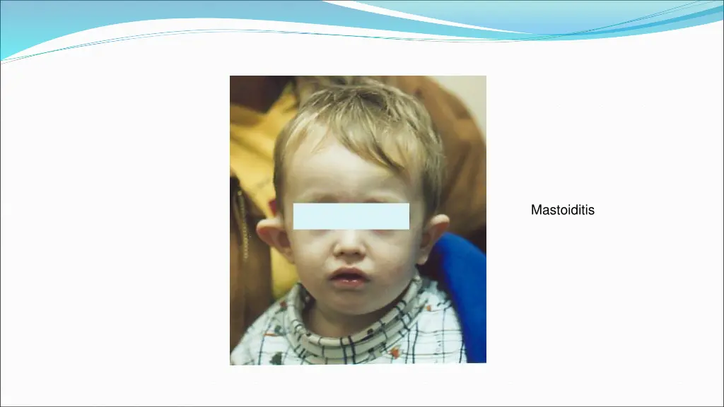 mastoiditis