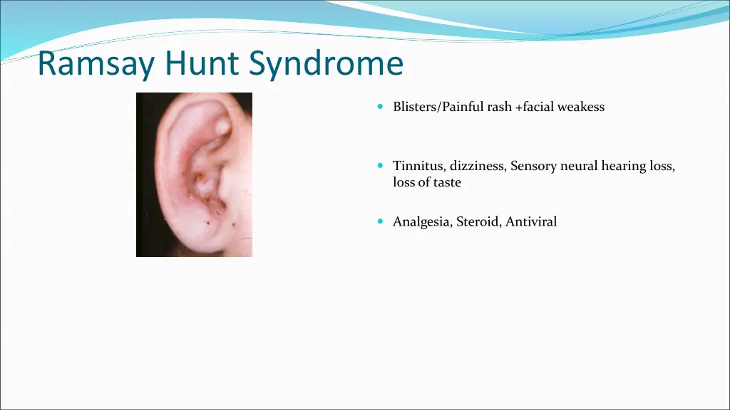 ramsay hunt syndrome